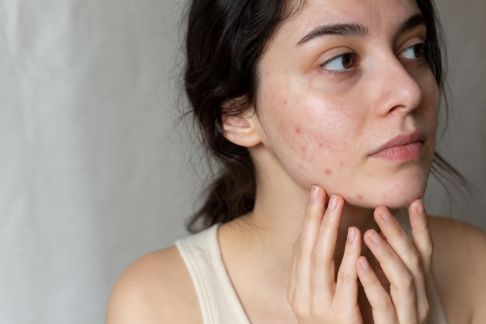 Poussée de boutons occasionnelle : s’en débarrasser sans agresser sa peau